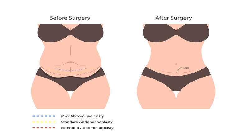 Mini, Standard and Extended Abdominoplasty